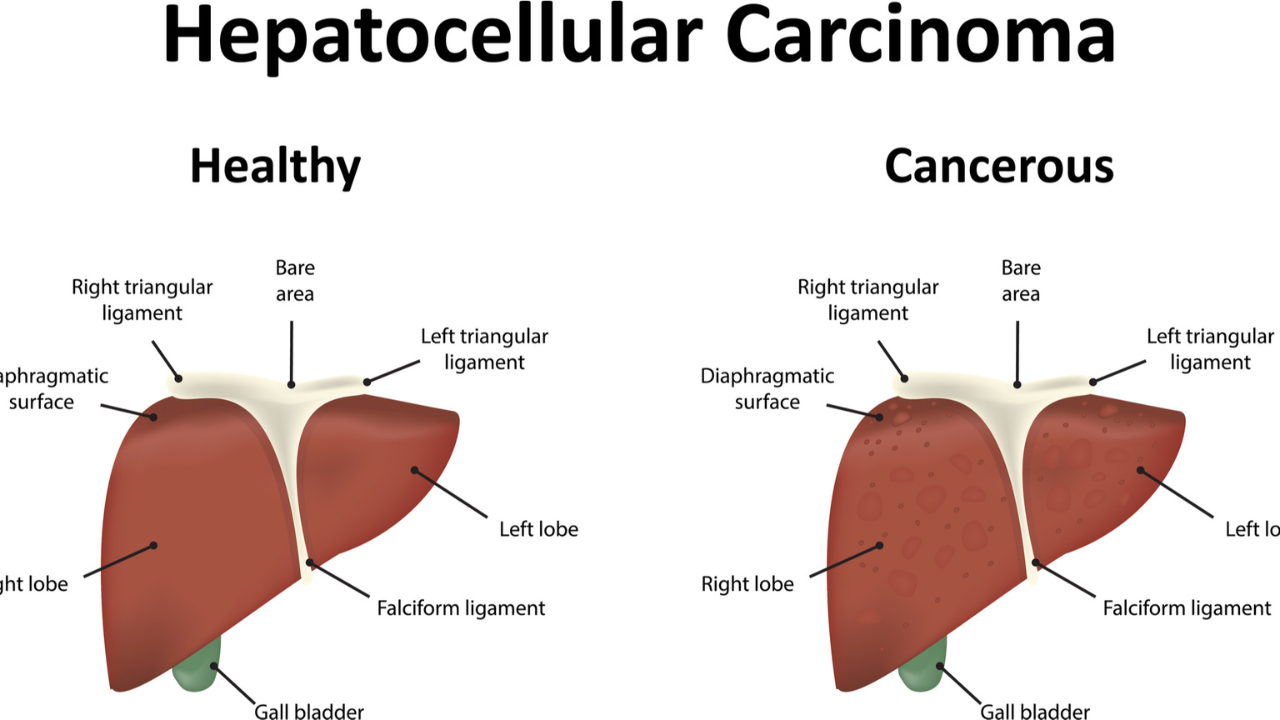 6 Things You Should Know About Liver Cancer