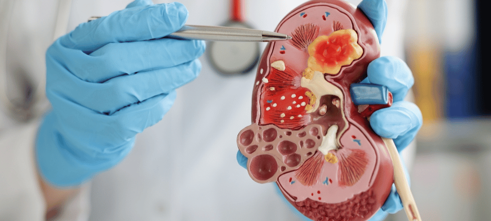 Kidney Cancer