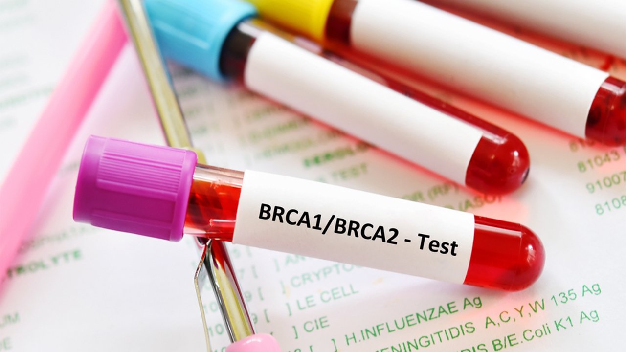 BRCA Gene Analysis In Breast Cancer