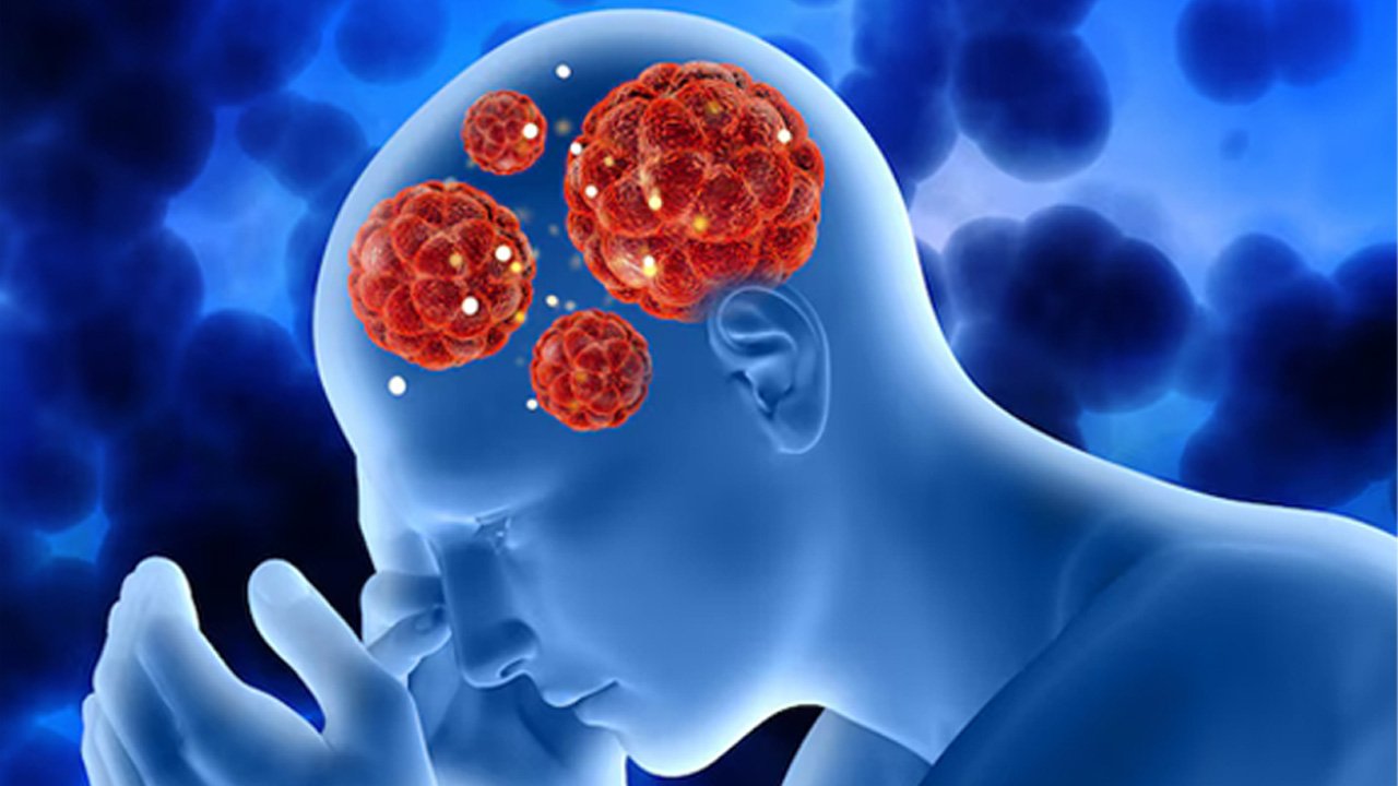 Symptoms And Signs Of Brain Cancer