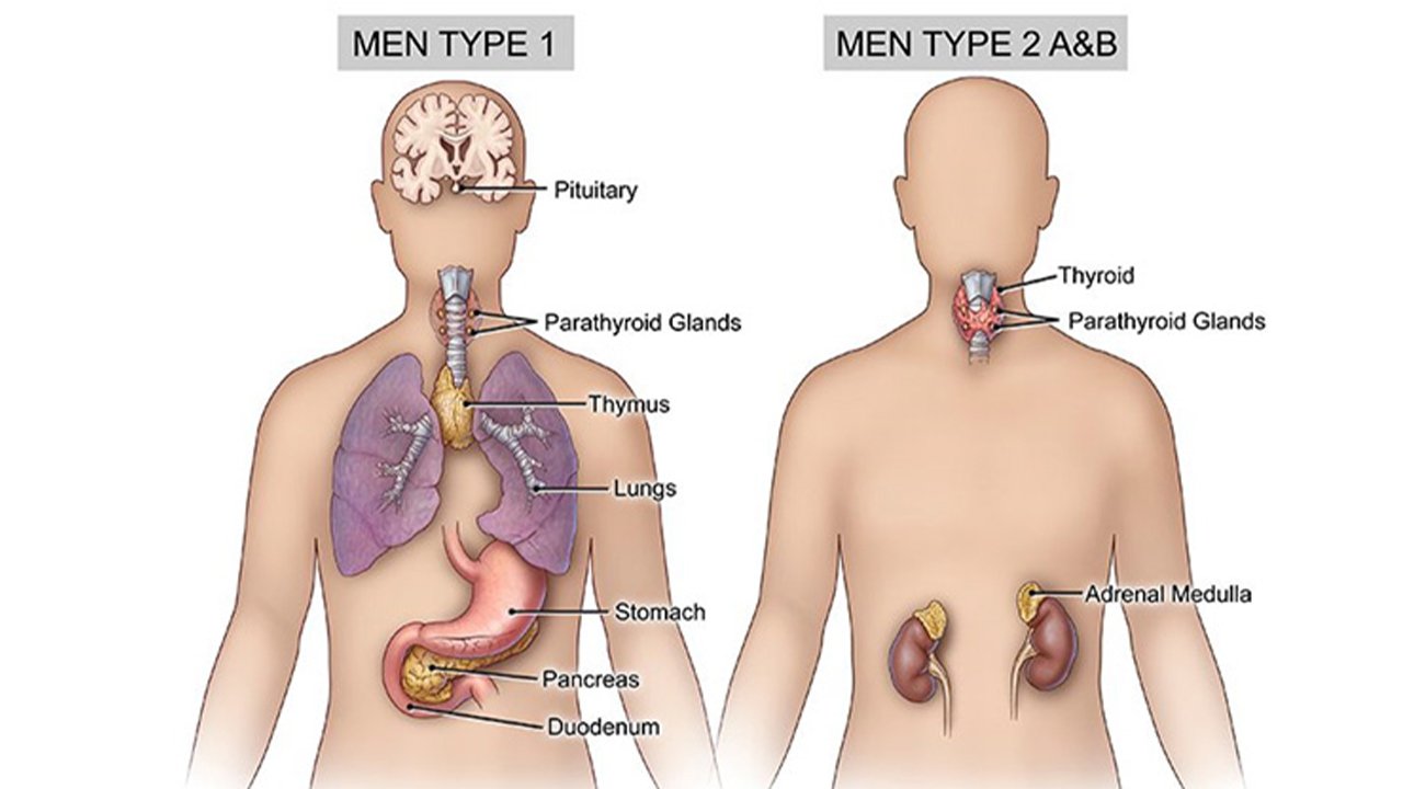 Multiple Endocrine Neoplasia (MEN) Syndromes