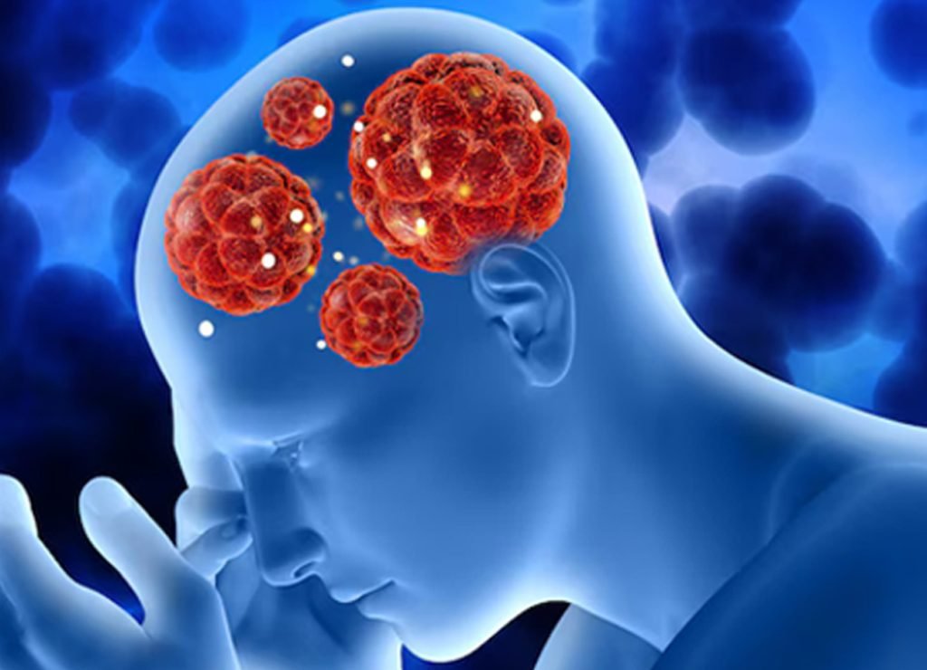 Symptoms And Signs Of Brain Cancer